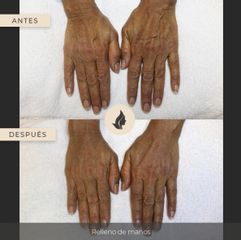 Antes y después de Relleno en mano con ácido hialurónico