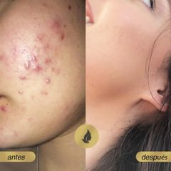 Antes y después de Peeling para el acné