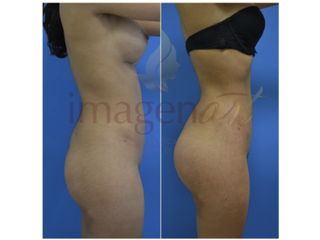 Antes y después de Gluteoplastia