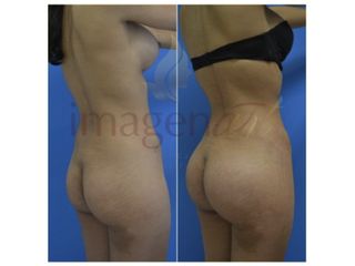 Antes y después de Gluteoplastia