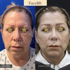 Antes y después de Lifting 