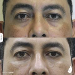 Antes y después de Relleno de Ojeras - Ácido Hialurónico 