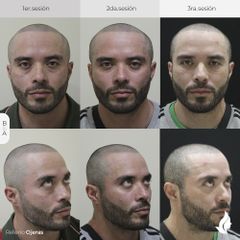 Antes y después de Relleno de Ojeras - Ácido Hialurónico 