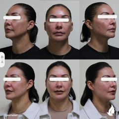 Rejuvenecimiento facial - Imagen Art Clinic