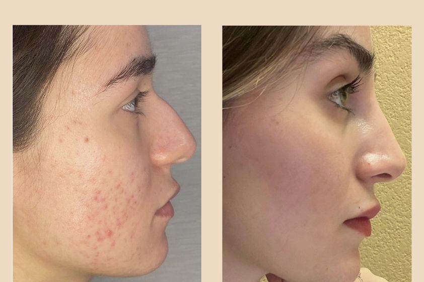 Peeling antes y después - 853102