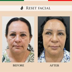 Rejuvenecimiento Facial - Imagen Art Clinic