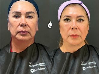 Rejuvenecimiento facial antes y después - 871392