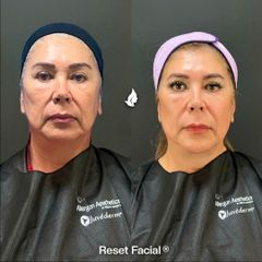 Rejuvenecimiento facial - Imagen Art Clinic