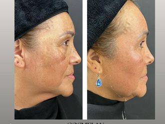 Peeling antes y después - 871393