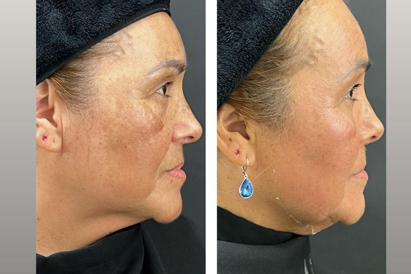 Peeling antes y después - 871393