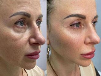 Rejuvenecimiento facial antes y después - 871397