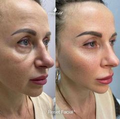 Rejuvenecimiento facial - Imagen Art Clinic