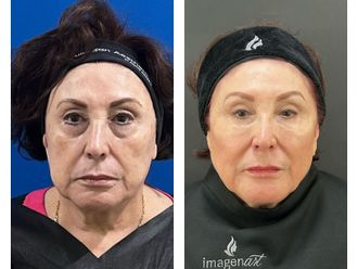 Rejuvenecimiento facial antes y después - 871398