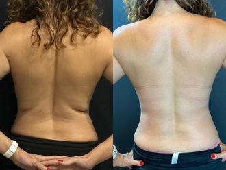 Radiofrecuencia antes y después - 856502