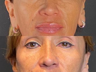 Tratamientos faciales - 856503