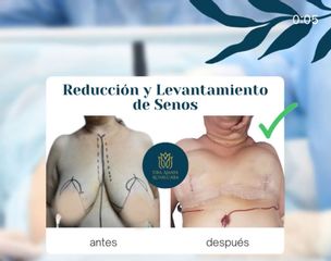 Reducción mamas - Dra. Amaya Ruvalcaba