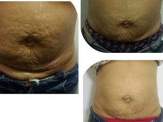 Antes y después de Radiofrecuencia