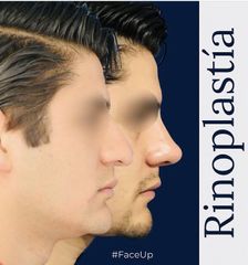 Rinoplastia - Face Up Puebla