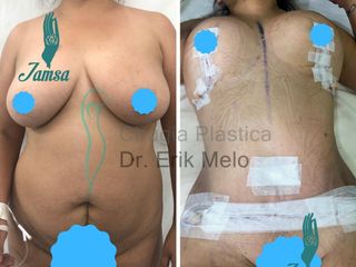 Antes y después de un tratamiento post operatorio
