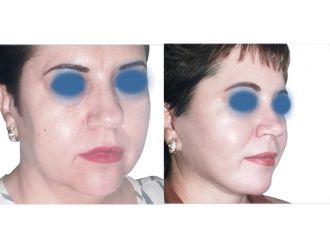 Rejuvenecimiento facial - 641846