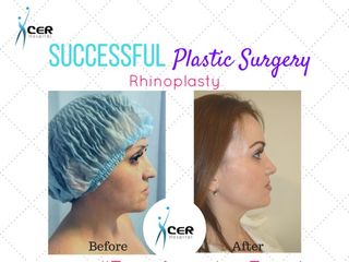 Before and After Rinoplastia