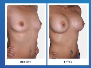 Mamoplastia de aumento 
