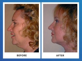 Cirugía facial