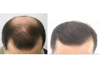 Antes y después de Trasplante de pelo