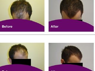 Antes y después de Trasplante de pelo