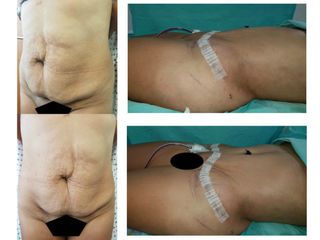 Antes y después de Abdominoplastia