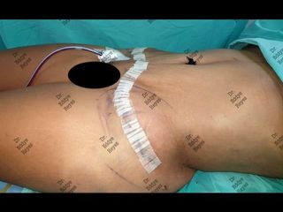 Lipoescultura