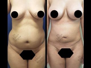 Antes y después de Lipoescultura