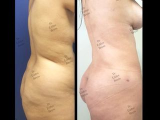 Antes y después de Lipoescultura