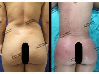 Antes y después de Lipoescultura