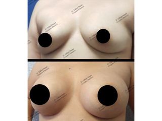 Antes y después de Aumento de busto