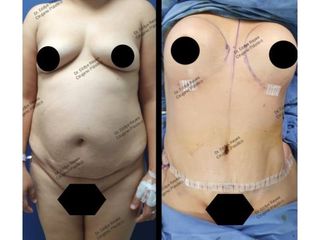 Antes y después de Lipoescultura