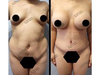 Antes y después de Lipoescultura