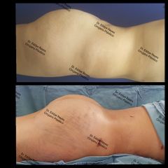 Antes y después de Lipoescultura