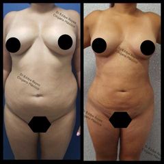 Antes y después de Lipoescultura
