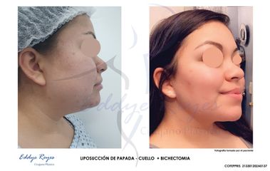 Liposucción de papada - Dr. Eddye Hernán Reyes Urbina