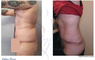 Abdominoplastia - Dr. Eddye Hernán Reyes Urbina
