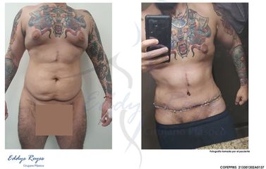 Abdominoplastia - Dr. Eddye Hernán Reyes Urbina