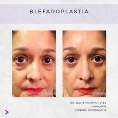 Blefaroplastia - Dr. Eddye Hernán Reyes Urbina
