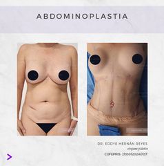 Abdominoplastia - Dr. Eddye Hernán Reyes Urbina
