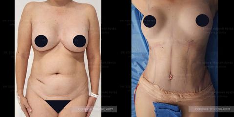 Abdominoplastia - Dr. Eddye Hernán Reyes Urbina