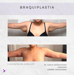 Braquioplastia - Dr. Eddye Hernán Reyes Urbina