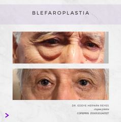 Blefaroplastia - Dr. Eddye Hernán Reyes Urbina
