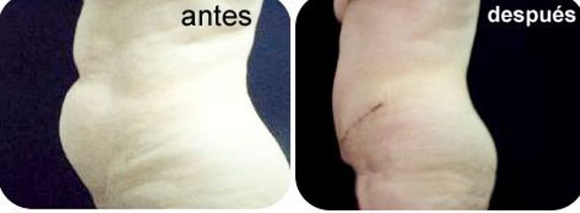 Antes y después de una abdominoplastia 