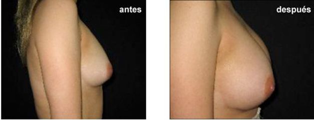 Antes y después de un aumento de busto 