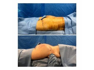 Antes y después de lipoescultura 
